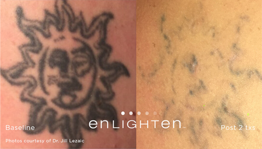 Rogue - tattoo Removal for men 2